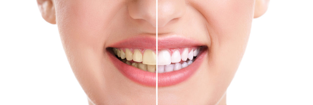 4 Things To Know About Teeth Whitening Teeth Whitening